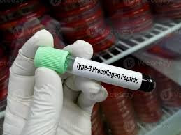 Serum Test , Procollagen Type III Peptide