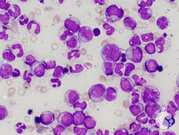 Oncomine (CMML)  chronic myelomonocytic Leukemia panel