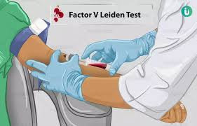 Factor V Leiden Mutation Analysis TEST
