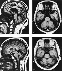 (Spino Cerebellar Ataxia) SCA 8