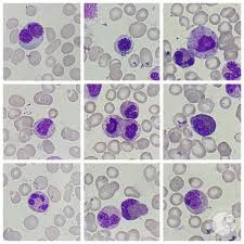 Oncomine myelodysplastic syndrome (MDS) panel