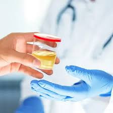 Porphobilinogen Qualitative Test (Random Urine)