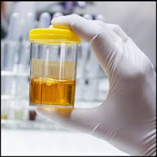 Porphobilinogen Qualitative (Random Urine) Test